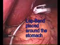 Adjustable Gastric Band Adjustable Gastric Band