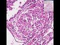 Histopathology Lung--Sarcoidosis Sarcoidosis