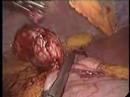 Resezione di Tumore gastrico per via laparoscopica