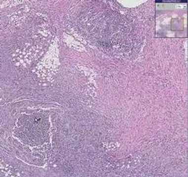 Histopathology Gut--Actinomycosis ...