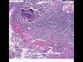 Histopathology Gut--Actinomycosis diverticulitis, abscess Histopathology Gut--Actinomycosis diverticulitis, abscess