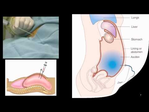 how to drain ascitic fluid