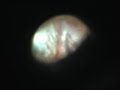 retina dekolman? ameliyat?: SBS-PPV-PFC-Silikon de?i?imi retina dekolman? ameliyat?: SBS-PPV-PFC-Silikon de?i?imi