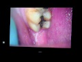 patient has many fractured teeth from grinding