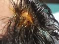 Home Cyst Surgery