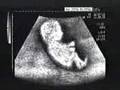 Deaf-Baby