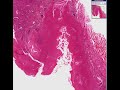 Histopathology Pharynx--Streptococcal tonsillitis