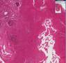 Histopathology Pharynx--Streptococcal tonsillitis