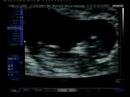 Eleanas 12 week scan