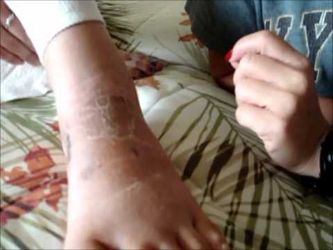 how to measure pitting edema