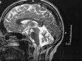 Spinocerebellar Ataxia