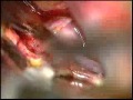 Fusiform Aneurysms of the Anterior Communicating Artery
