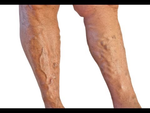 how to get rid varicose veins