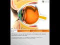 La myopie 3D: Quantel Medical