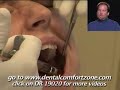 YouTube: Tooth Extraction Demonstration