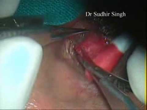 how to unclog sweat glands in armpits