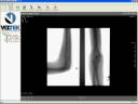 My X-rays on my Arm