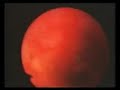CARCINOID TUMOR: BRONCHOSCOPIC RESECTION / TUMOR CARCINOIDE: RESECCIONBRONCOSCOPICA