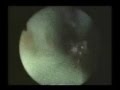 videos de CARCINOID TUMOR: BRONCHOSCOPIC RESECTION / TUMOR CARCINOIDE: RESECCIONBRONCOSCOPICA