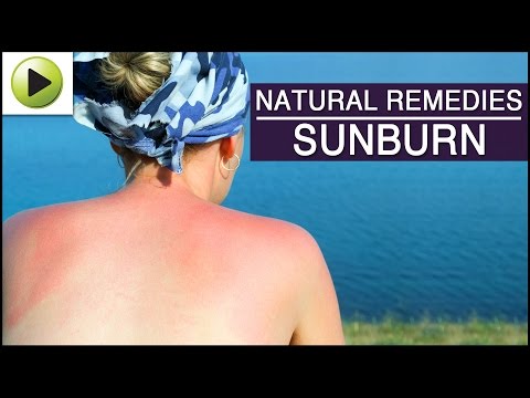 how to treat sunburn