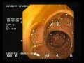 Spiral Enteroscopy, Arteriovenous Malformation (AVM) Laserotherapy Spiral Enteroscopy, Arteriovenous Malformation (AVM) Laserotherapy