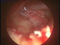 Endoscopic cholesteatoma surgery Endoscopic cholesteatoma surgery