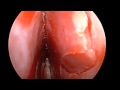 Septoplasty by Using The Septal Stapler Septoplasty by Using The Septal Stapler