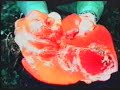 phobia-vix2-section-pv.html