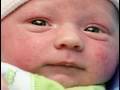 Baby Acne (Baby Health Guru)