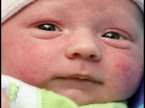 how to treat newborn acne