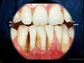HALITOSIS