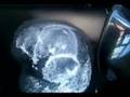 Car Dent Removal with Hair Dryer and Compressed Air