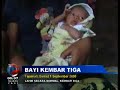 Bayi Kembar 3 Terlahir Secara Normal