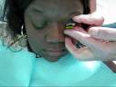 Specialty Lenses for a post-Transplant Keratoconus Patient