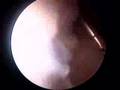 Bursitis Removal
