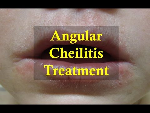 how to cure angular cheilitis