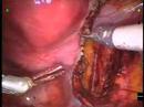 Robotic Radical Hysterectomy --by Dr. Patrick Anderson