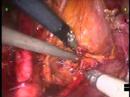 Robotic Radical Hysterectomy --by Dr. Patrick Anderson
