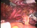 Robotic Radical Hysterectomy --by Dr. Patrick Anderson