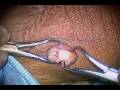 Mini Incision No-Scalpel Vasectomy Reversal from California Vasectomy & Reversal Center