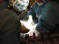 my 2nd cesarian operation