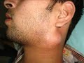 Incision and Drainage of a Neck Abscess