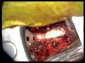 spinal disc prolapse and replacement OP-START spinal disc prolapse and replacement OP-START