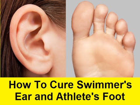 how to cure swimmers ear
