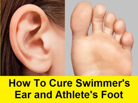 how to treat swimmer's.ear