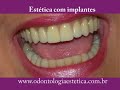 Clínica Odontológica de Reabilitação Bucal e Estética Avançada Implantes Dentários Curitiba e Santo Antônio da Platina Paraná Brasil Brazil