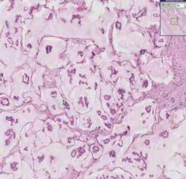 Histopathology Breast--Colloid carcinoma