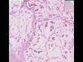 Histopathology Breast--Colloid carcinoma