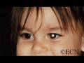 Retinoblastoma