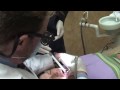 Porcelain Veneers Demonstration